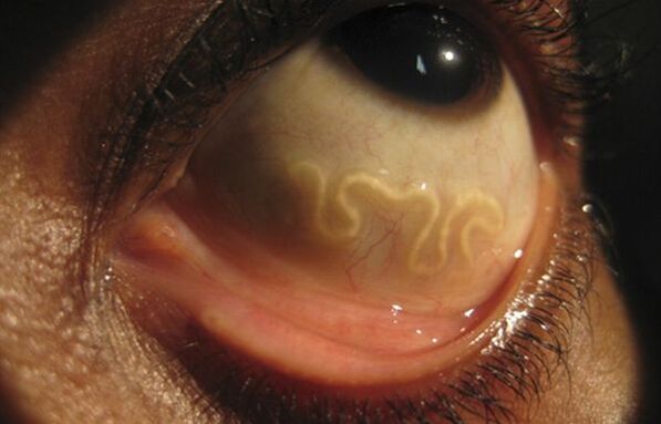 Cacing Loa Loa hidup di dalam mata manusia dan menyebabkan kebutaan